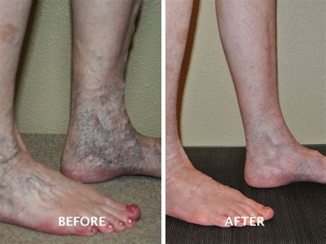 Varicose Vein Treatment Gallery Advanced Vein Therapy