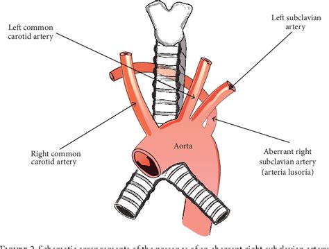 Figure 2 From The Aberrant Right Subclavian Artery Arteria Lusoria