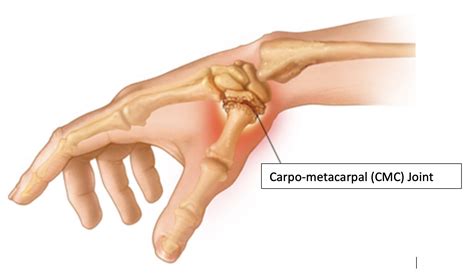 Base Of Thumb Arthritis Aberdeen Virtual Hand Clinic