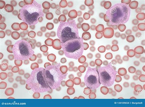 Strong Increase Of Non Functional White Blood Cells Called Leukemia