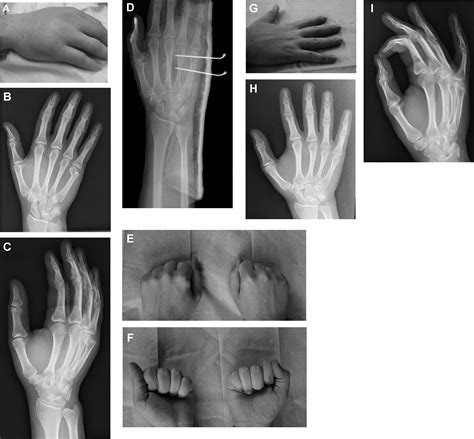 Fractures Of The Neck Of The Fifth Metacarpal Bone Medium Term Results