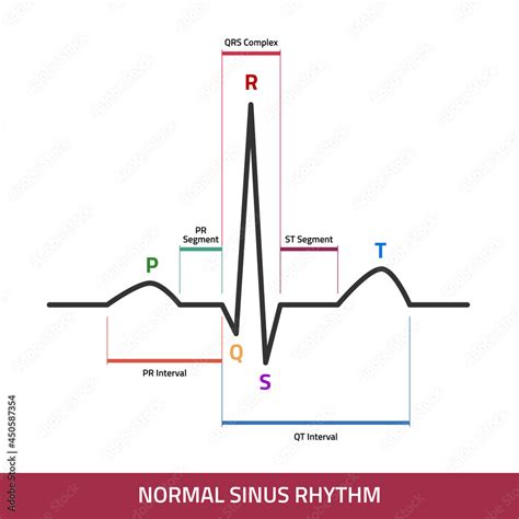 Ekg Showing Normal Heartbeat Wave Ecg Of Normal Sinus Rhythm