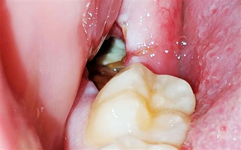 Normal Socket After Tooth Extraction Vs Dry Socket
