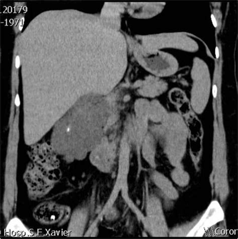 Retroperitoneal Cystic Lymphangioma Eurorad