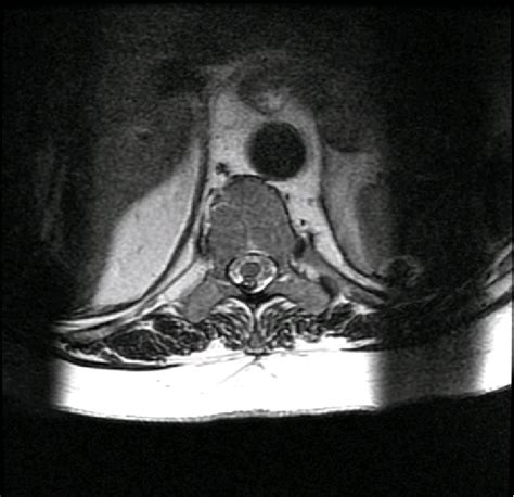 T2 Weighted Transverse View Of Thoracic Spine Mri At Upper T10 Level