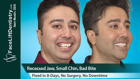 Recessed Jaw Small Chin Bad Bite Fixed In 8 Days No Surgery Youtube