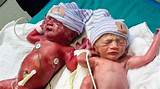 Pictures of Twin To Twin Transfusion Treatment
