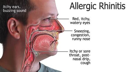 What Is Allergic Rhinitis