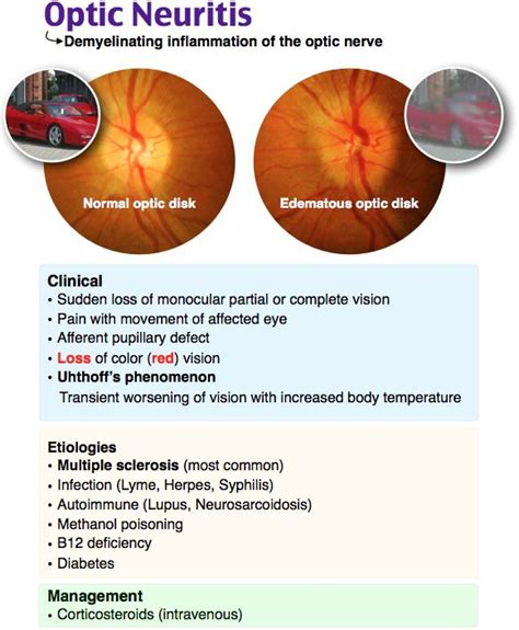 Optic Neuritis Optic Neuritis Medical Mnemonics Optometry Education
