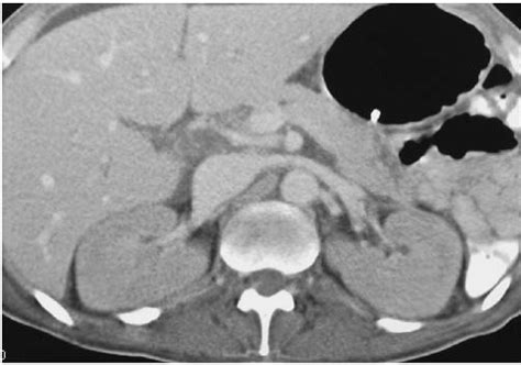 Get detailed information about the treatment of newly diagnosed and recurrent renal cell cancer in this summary for clinicians. Renal Failure | Radiology Key