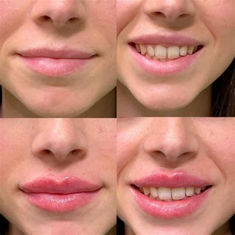 Aumento labios ácido hialurónico - Clínicas LOVE
