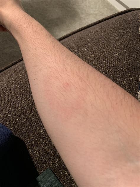 Got This Bite With A Ring Around It What Bug Is This From R