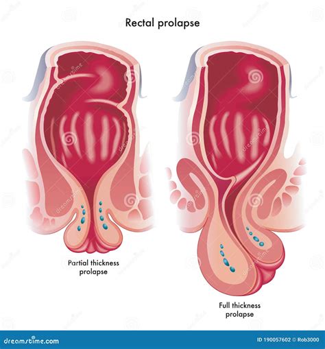 Medical Illustration Showing Two Types Of Rectal Prolapse Stock Vector
