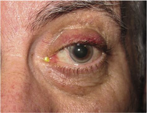 Eyelid And Ocular Surface Carcinoma Diagnosis And Management Clinics