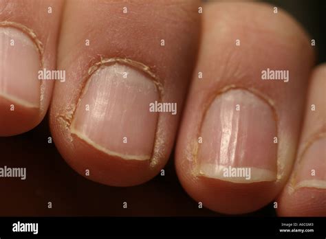 Dry Cracked Fingers Stock Photo Alamy