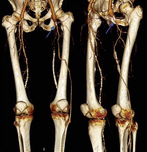 Profunda Femoral To Anterior Tibial Artery Bypass To Treat Critical