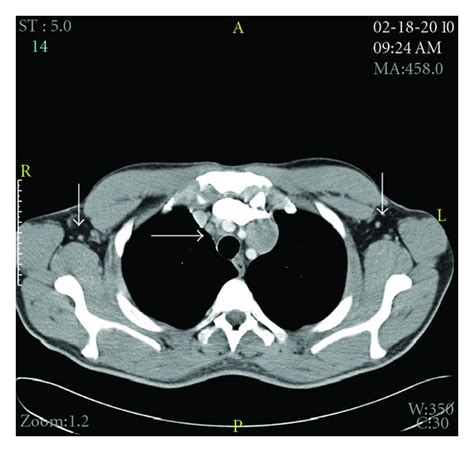 Ct Chest Showing Mediastinal Lymphadenopathy And Bilateral Axillary