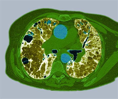 Lung Fibrosis Ct Scan Photograph By Du Cane Medical Imaging Ltd Pixels