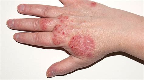 ¿qué Es Un Eczema Y Cómo Aliviarlo Remedio Casero Efectivo