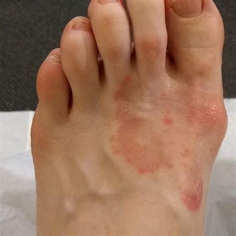 Fungal Dorsum Footman Podiatry And Gait Analysis Clinic Hot Sex Picture