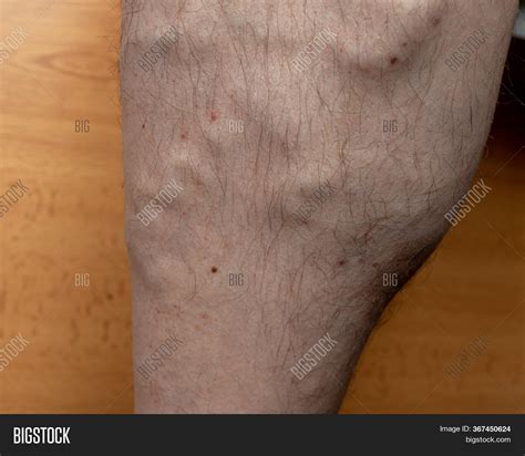 External Damage Skin Image And Photo Free Trial Bigstock