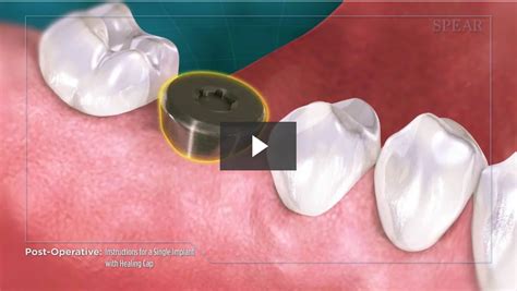 Post Operative Instructions For A Single Implant With Healing Cap Cosmetic Dentistry