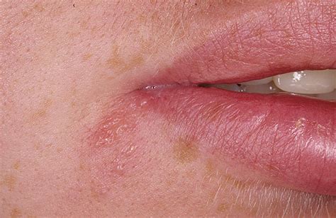 The first oral infection with hsv usually causes many painful sores inside the mouth (herpetic the lip sore is called a cold sore or fever blister (so. Herpes on Lip Pictures - 25 Photos & Images / illnessee.com