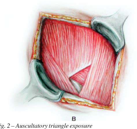 Figure 2 From Minimally Invasive Thoracotomy Muscle Sparing