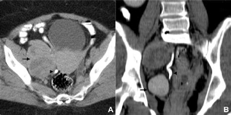 Pelvic Lymph Node Metastasis In A 60 Yearold Woman With A Cervical