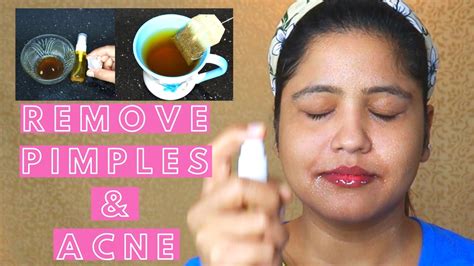 Homemade Remedies To Remove Pimples And Acne Marks Fast And Naturally