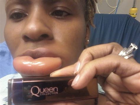 Woman Gets With Swollen Lips After Using A Dubious Lipstick Before And