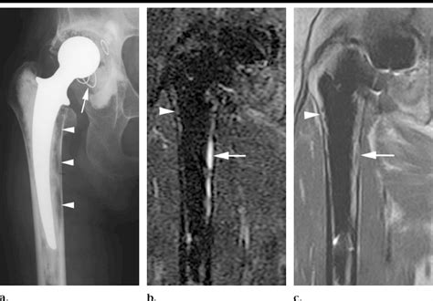 A Anteroposterior Radiograph Of The Right Hip In A 70 Year Old Woman