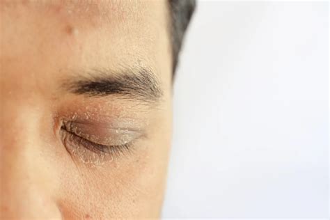 Contact Allergy In Singapore The Dermatology Clinic Dr Uma