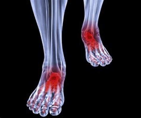 Arthritic Foot Ankle Care In Cary NC Ankle And Foot Doctors