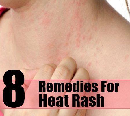 Tremetski Com Skin Rash Treatments Heat Rash Is Also Referred To As My XXX Hot Girl