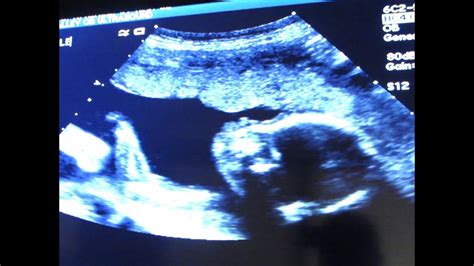 Rachels 20 Week Pregnancy Ultrasound With Sound Its A Youtube