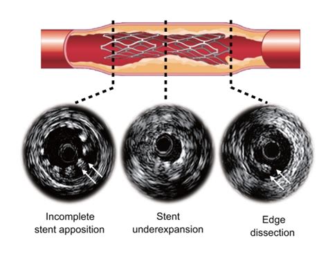 Stent Related Complications After Stent Deployment Download