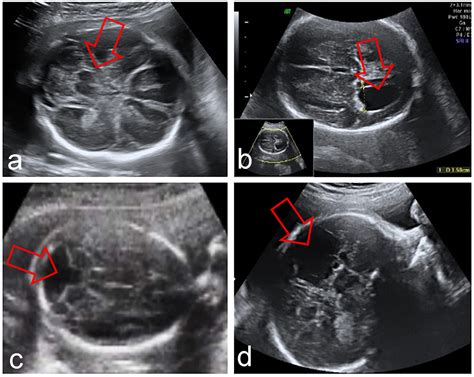 Outcome Of Fetuses With Abnormal Cavum Septi Pellucidi Experience Of A Tertiary Center Zorila