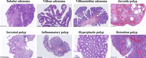 Different Types Of Colonic Polyps With Hematoxylin Eosin Staining Download Scientific Diagram