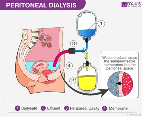 Peritoneal Dialysis Catheter Types