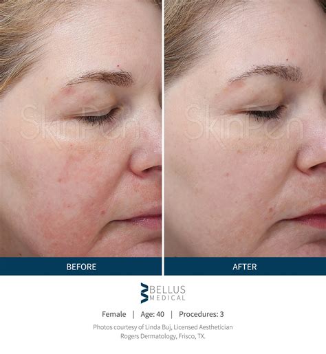 Before And After Microneedling Front Range Dermatology