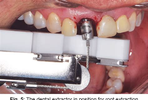 Figure 5 From Atraumatic Extraction Implant Placement And Immediate