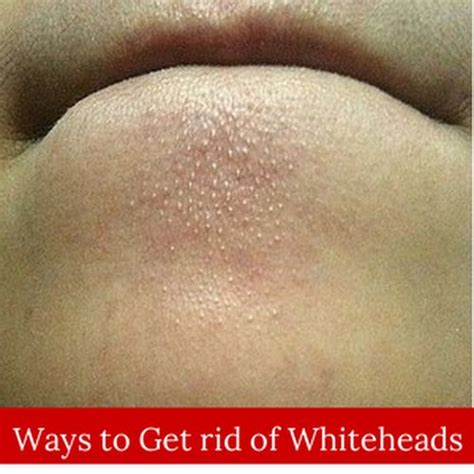 How To Get Rid Of Whiteheads Editor Head To And How To Get Rid