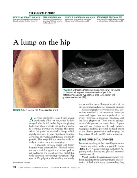 A Lump On The Hip Cleveland Clinic Journal Of Medicine