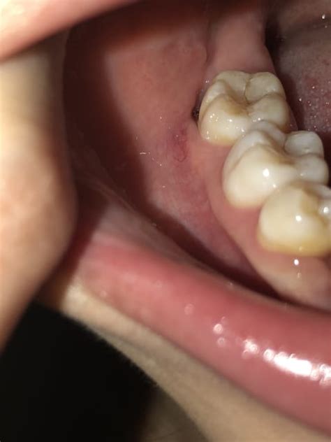 Why Do I Have Holes Where My Wisdom Teeth Were A Pictures Of Hole 2018
