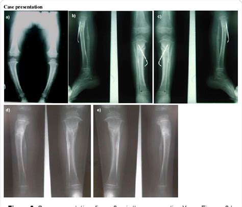 Figure 3 From Modified Oblique Proximal Tibial Osteotomy For Deformity