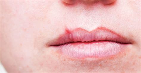 50 Shocking Facts Unveiling The Prevalence Of Oral Herpes 2024