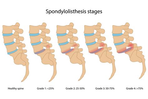 Spondylolisthesis Specialist Orange Ca Dr S Samuel Bederman