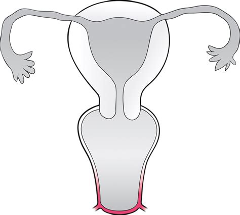 Müllerian Duct Anomalies And Mimics In Children And Adolescents