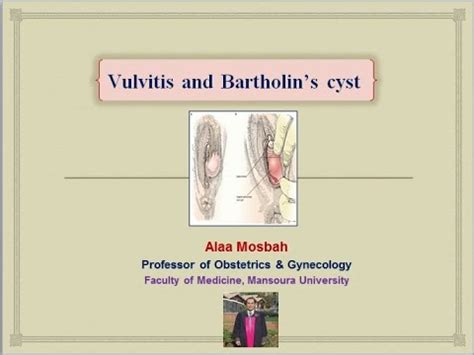 Vulvitis And Bartholins Cyst YouTube